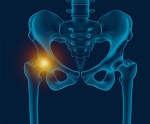 Hip Pain and joint pain