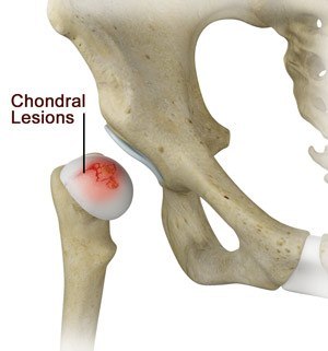 Chondral Lesions or Injuries